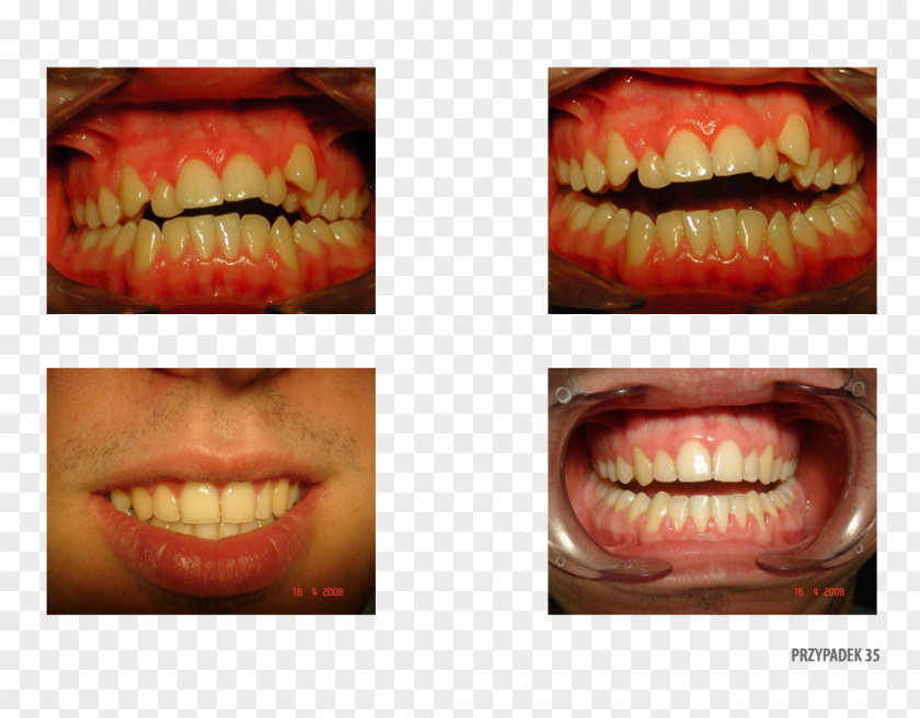 Camera Tooth Gingivoplasty Gums Ortoprotex PNG