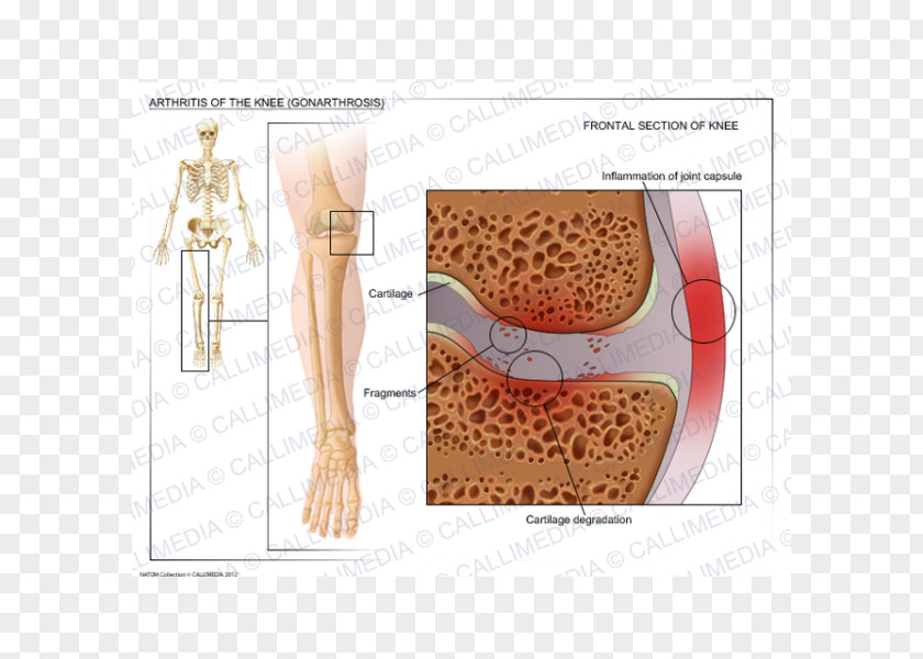 Arm Shoulder Knee Osteoarthritis Arthritis PNG