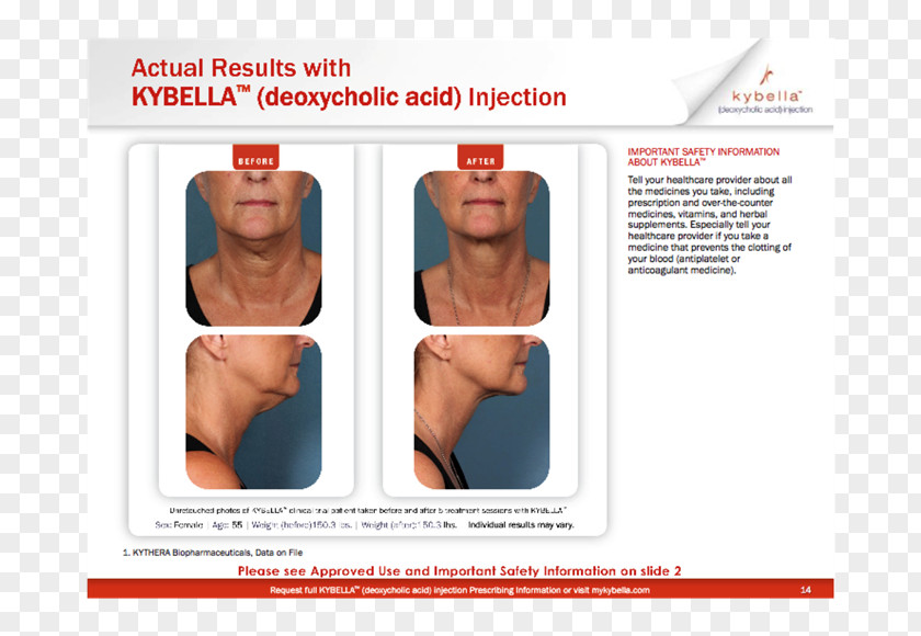 Nonsurgical Liposuction Surgery Deoxycholic Acid Dermatology Chin Submental Triangle PNG
