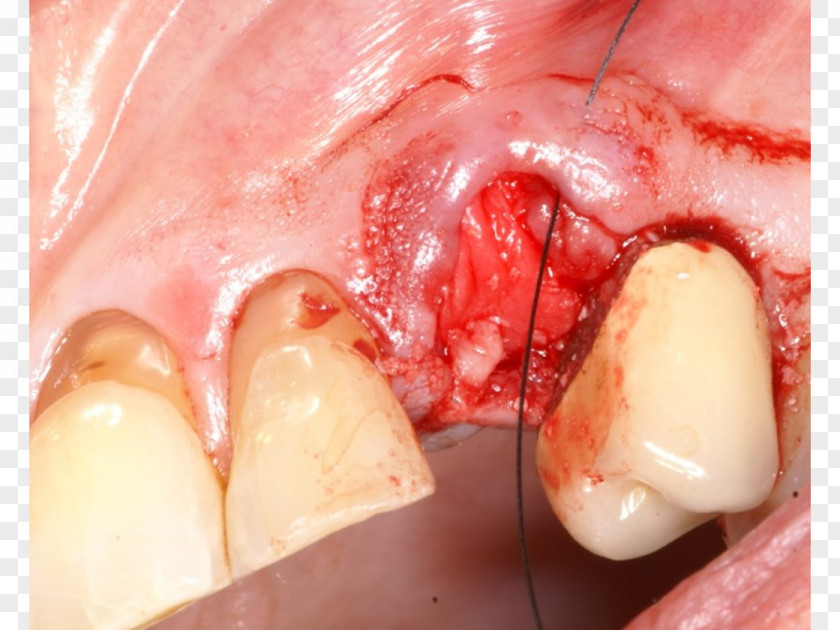 Forage Well Drilling Tooth Directional As Osteotomy PNG