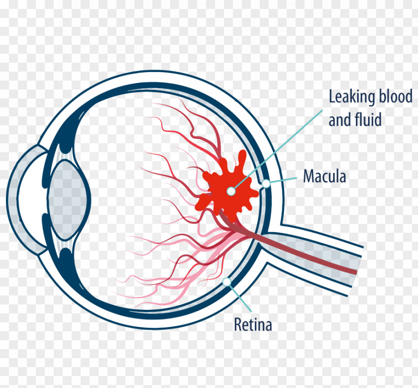 Eye Macula Of Retina Macular Edema Diabetic Retinopathy PNG