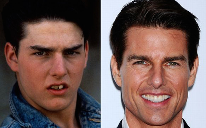 Tom Cruise Teeth Celebrity Dentistry Veneer PNG