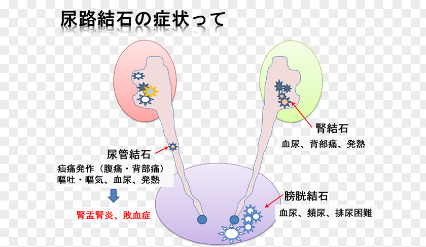 Kidney Disease Stone Calculus Excretory System Urology Cancer PNG