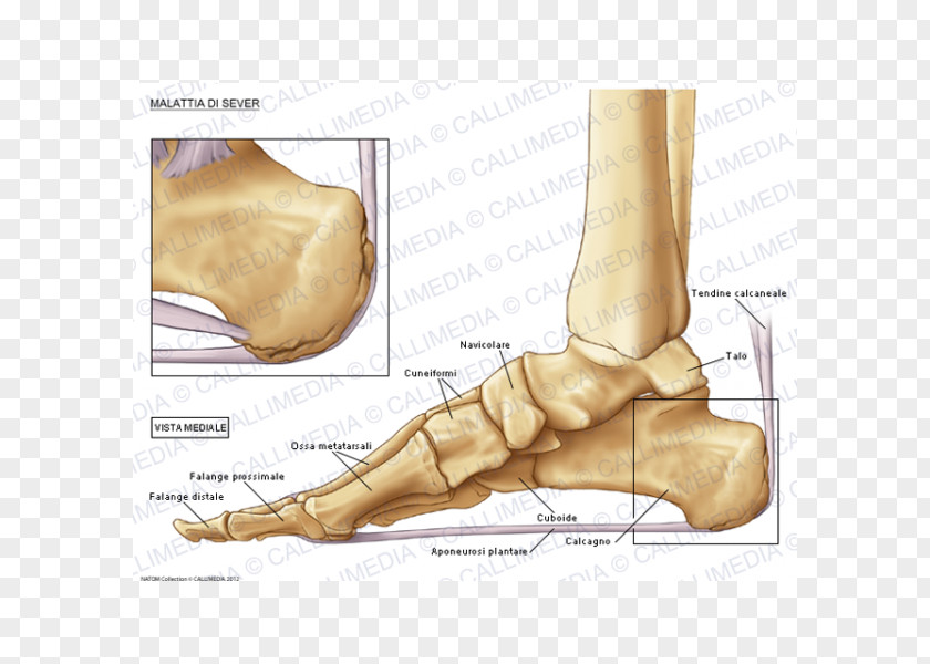 Human Body 3D Foot Köhler Disease Bone Osteochondrosis PNG