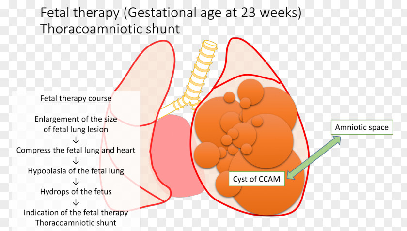 Congenital Pulmonary Airway Malformation Shunt Fetus Lung Cyst PNG