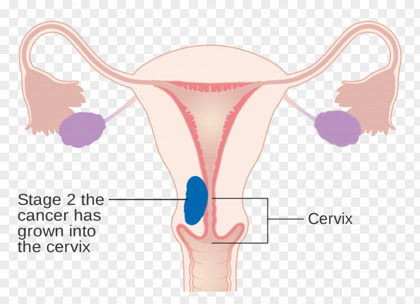 Cervical Cancer Endometrial Uterus Staging Ovarian PNG