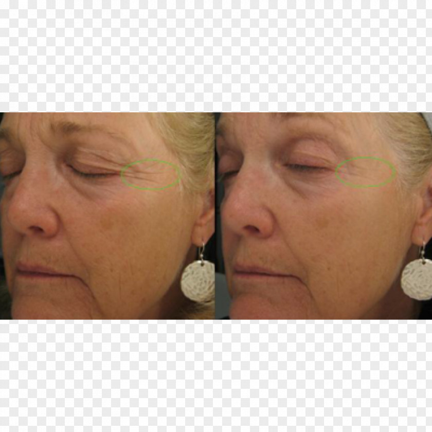 Face Cheek Wrinkle Anti-aging Cream Rhytidectomy PNG