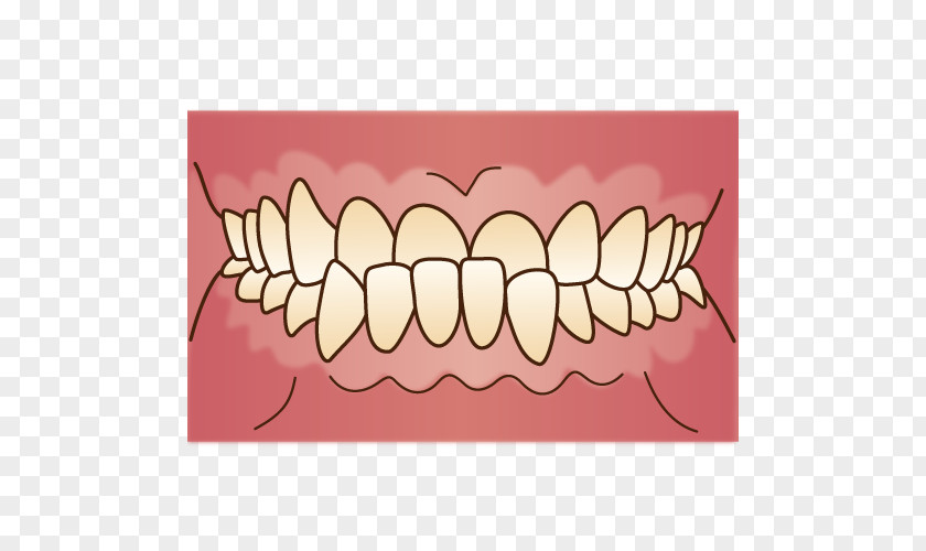 Orthodontics Crossbite Prognathism 歯科 Malocclusion Dentist PNG