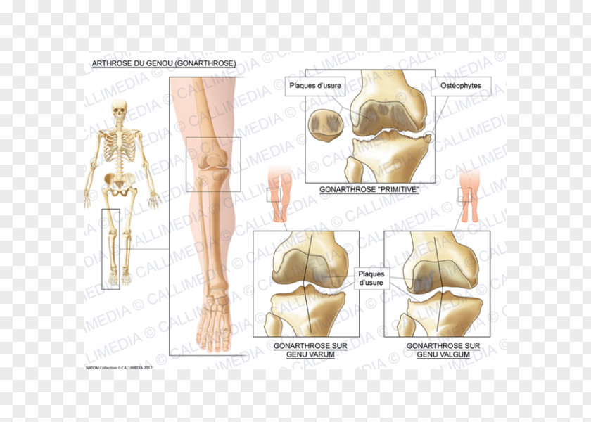 Artrosis De Rodilla Knee Osteoarthritis Arthritis PNG