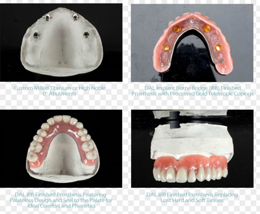 Bridge Tooth Dental Implant Prosthesis Dentures PNG