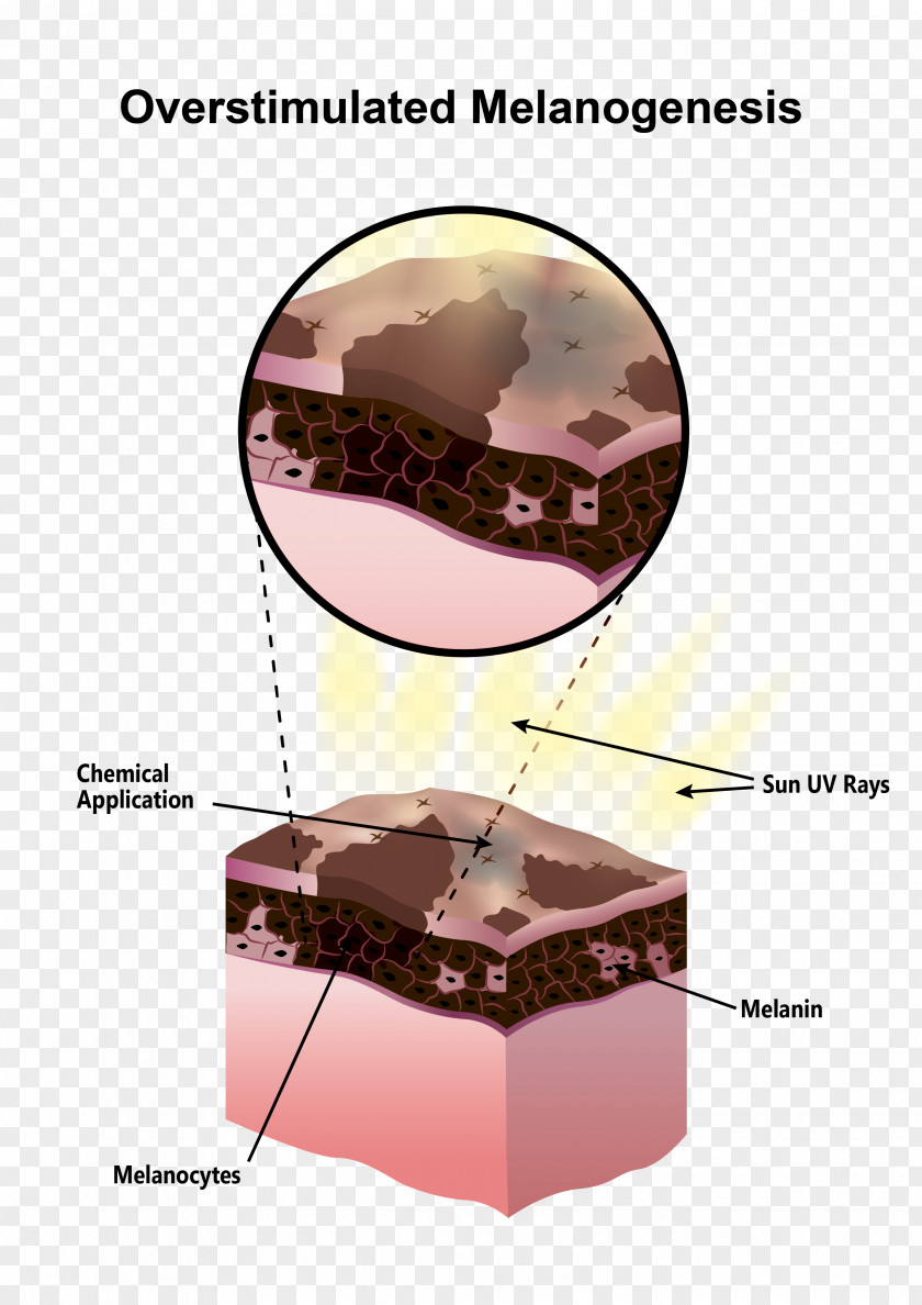 Melanin Hyperpigmentation Hypopigmentation Melanocyte Skin PNG