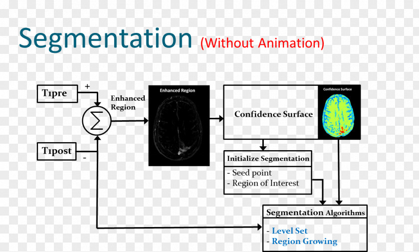 Segmentation Image Brain Tumor Magnetic Resonance Imaging Neoplasm PNG