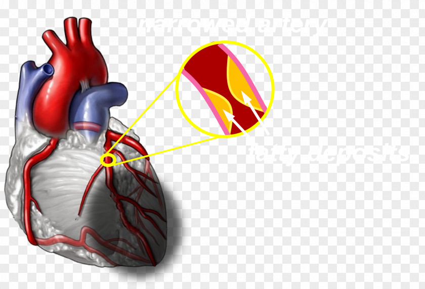 Old Men Heart Attack Coronary Artery Disease Cardiovascular Myocardial Infarction Health PNG