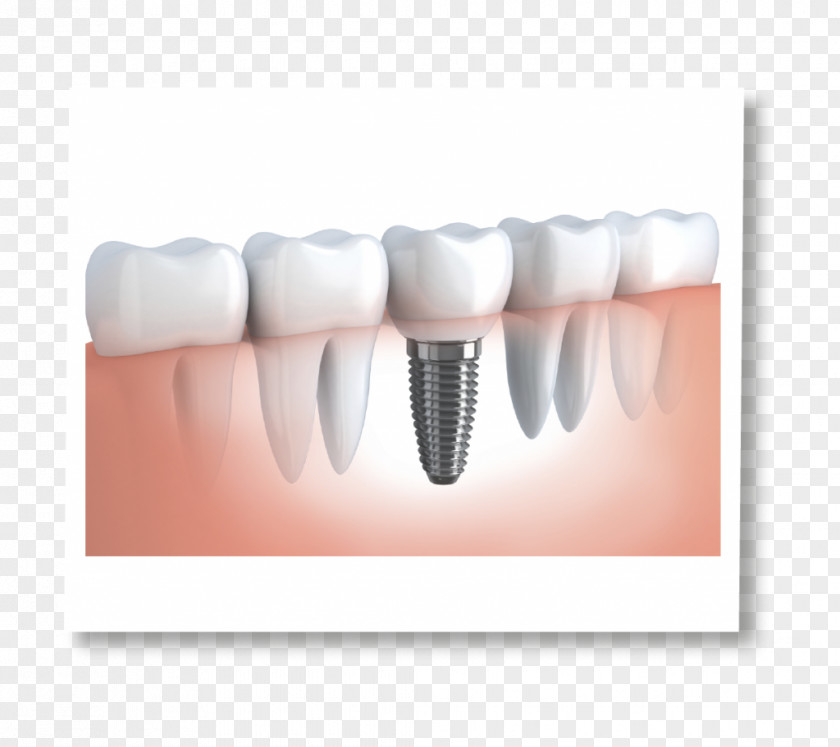 Crown Dental Implant Dentistry Dentures PNG