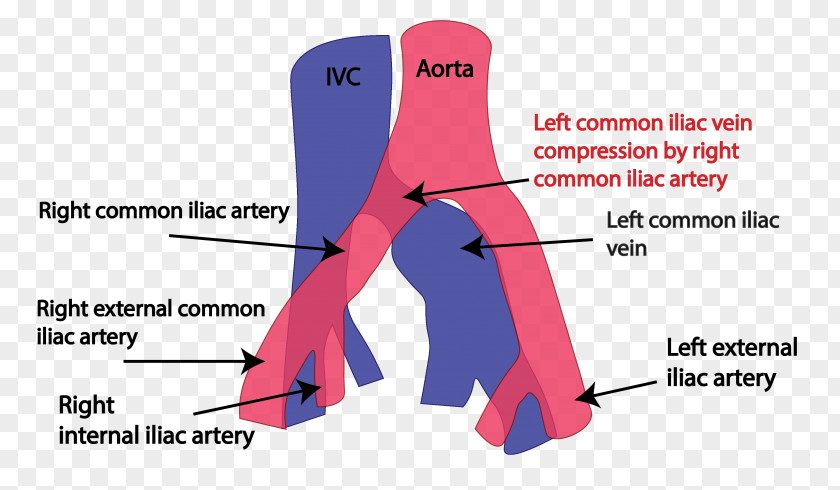 Common Iliac Vein May–Thurner Syndrome Artery Iliofemoral Ligament PNG