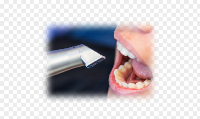 Moire Tooth Image Scanner CAD/CAM Dentistry Escáner PNG