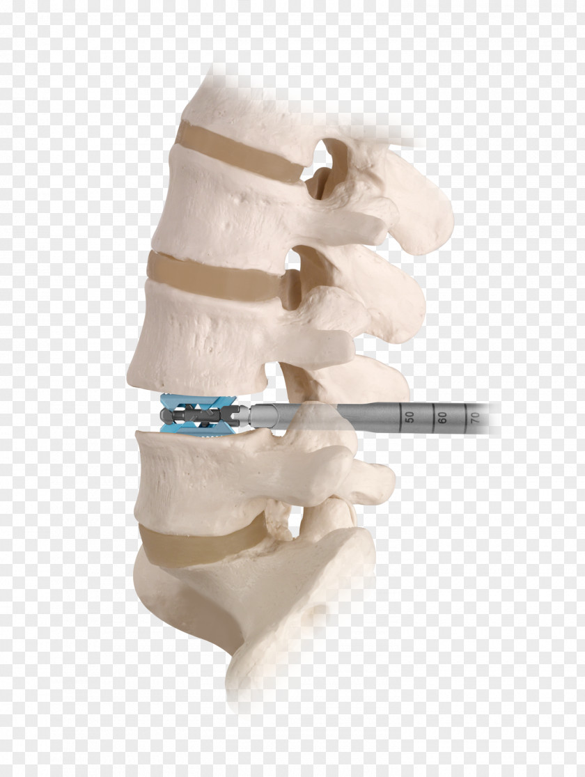 Spinal Fusion Vertebral Column Decompression Human Back Lumbar PNG