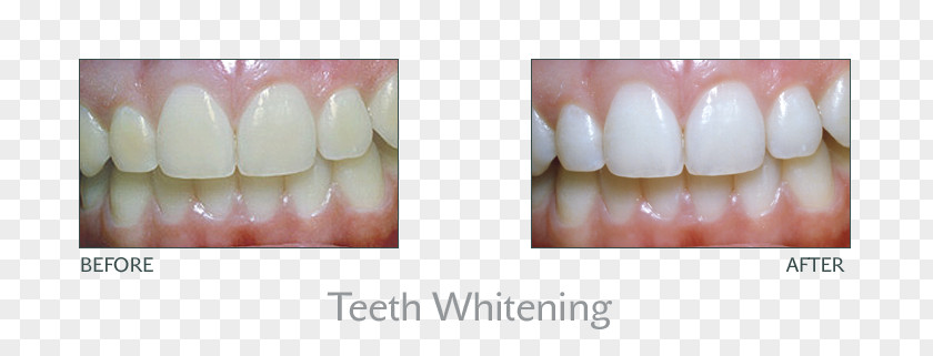 White Tooth Whitening Dentistry Human PNG