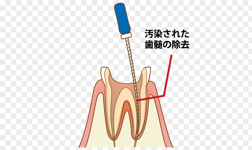 Captions Tooth Dentist 歯科 Endodontic Therapy Root Canal PNG