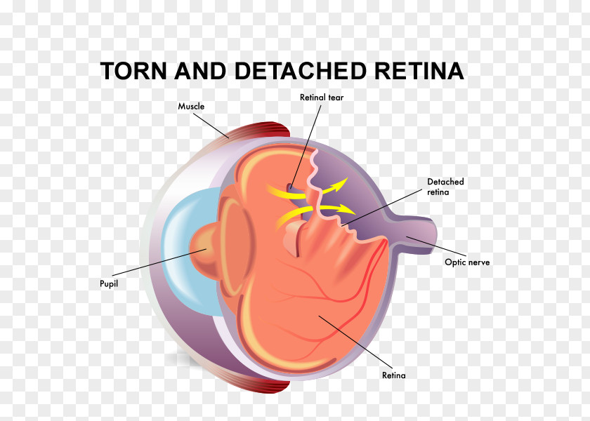 Torn Retinal Detachment Vitreous Body Tears Eye PNG