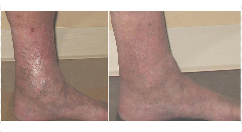 Varicose Veins Calf Ankle Knee Neck Skin PNG