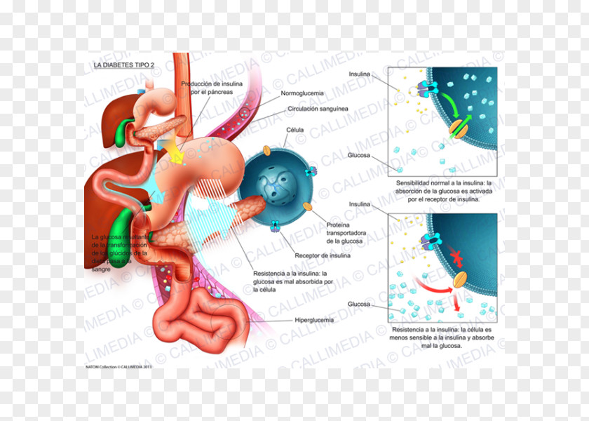 Diabetes Cartoon Mellitus Type 2 Illustration Internal Medicine Niimi Clinic PNG