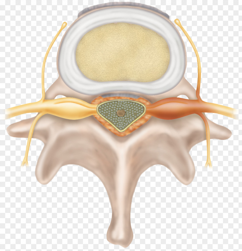 Spinal Disc Herniation Intervertebral Cervical Vertebrae Degenerative Disease Fusion PNG