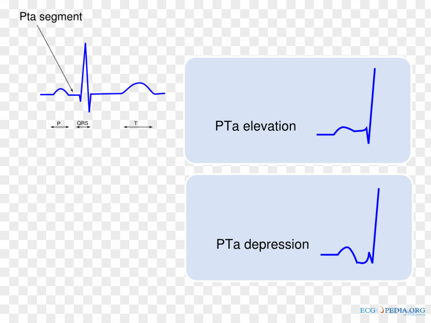 P Wave Electrocardiogram Electrocardiography QRS Complex Sinus Rhythm PNG