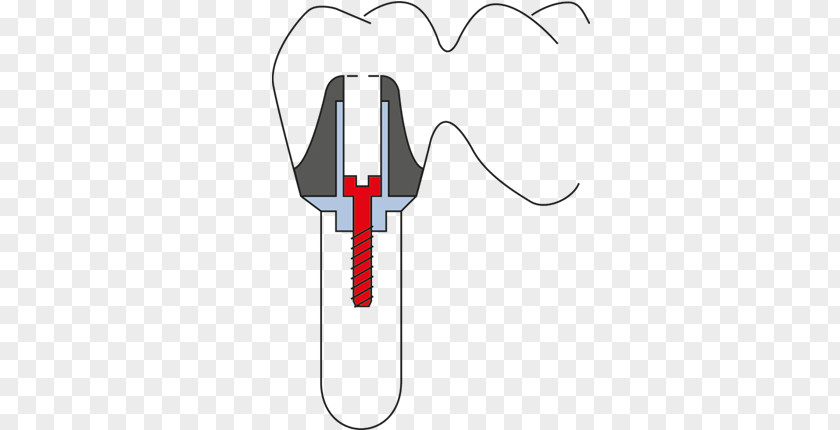 Dental Abutment Computer Software CAD/CAM Dentistry Sirona Systems PNG