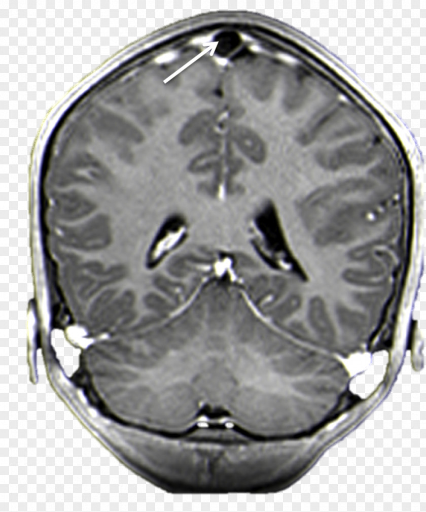 Brain Arachnoid Granulation Superior Sagittal Sinus Magnetic Resonance Imaging Mater PNG
