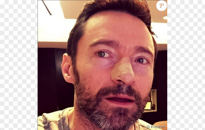 Golden Beach Hugh Jackman The Wolverine Sunscreen Skin Cancer Basal-cell Carcinoma PNG