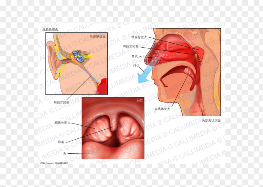 23060 Adenoid Hypertrophy Tonsillitis Infection PNG