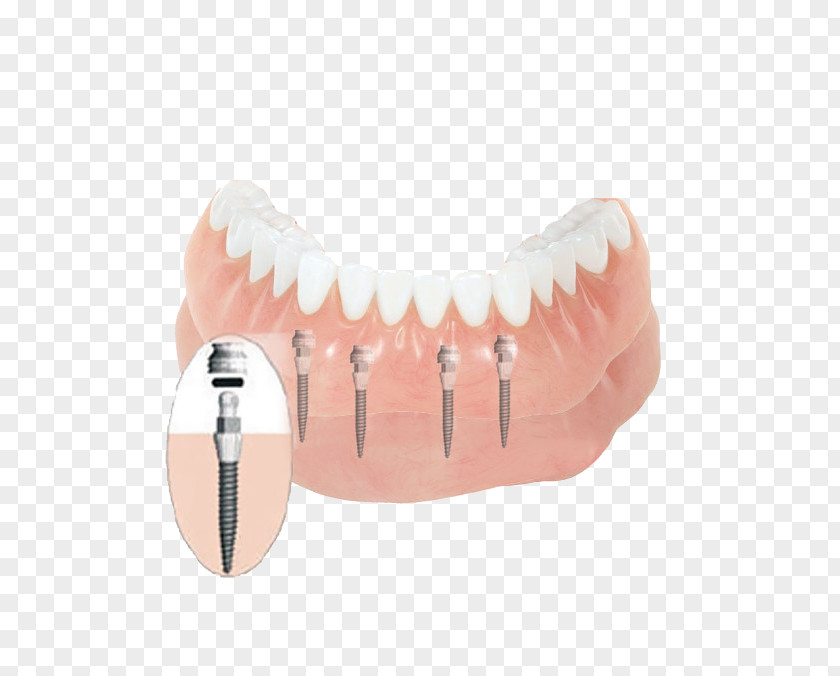 Health Tooth Dentures Dental Implant Dentistry PNG