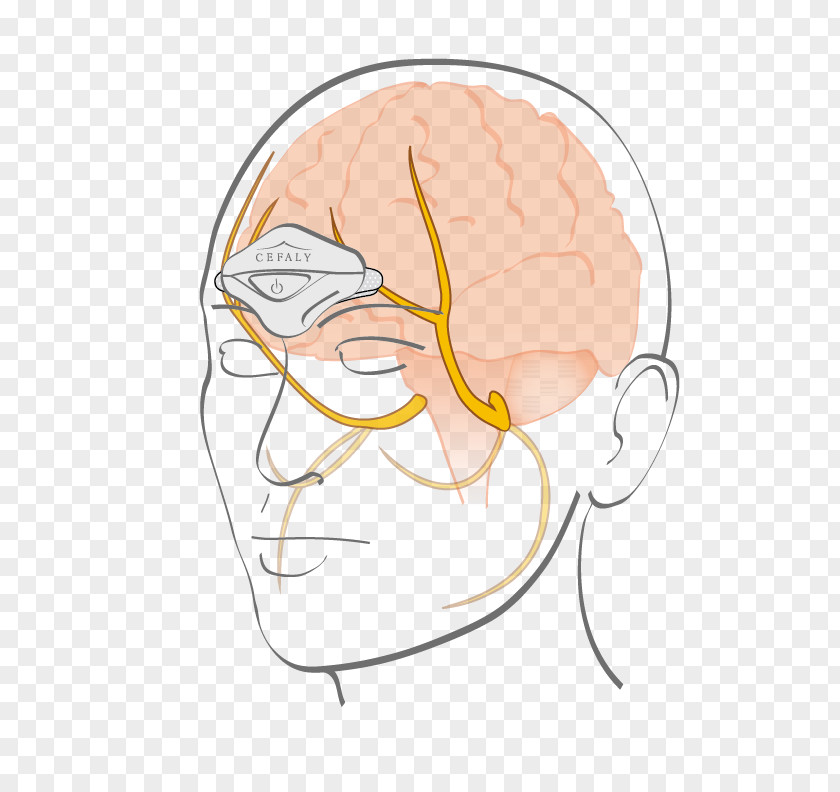 Neurostimulation Cefaly Electrode Trigeminal Nerve Migraine Neuralgia PNG