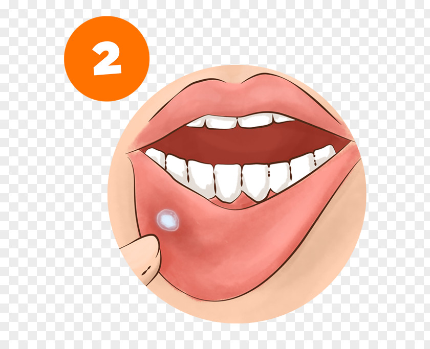 Tooth Mouth Ulcer Miconazole Oral Administration Tongue PNG ulcer administration Tongue, mug for mouth-rinsing or tooth-cleaning clipart PNG