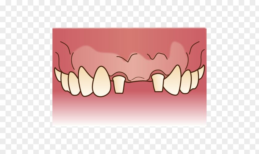 Bridge Tooth Dentures Dentist 歯科 PNG