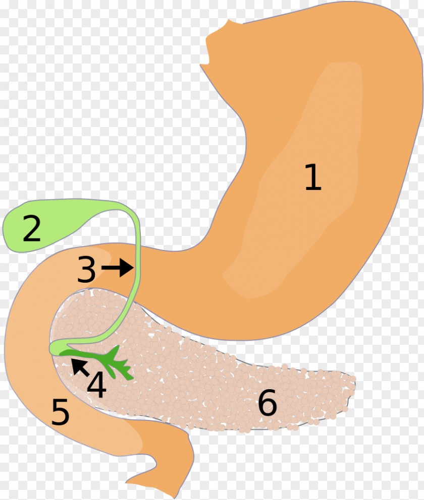 Papillentumor Pancreas Duodenum Gallbladder Pancreatitis PNG
