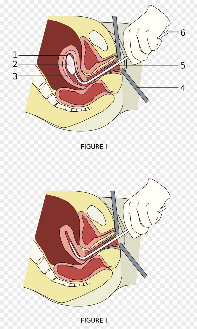 Pregnancy Vacuum Aspiration Surgery Abortion Miscarriage Therapy PNG