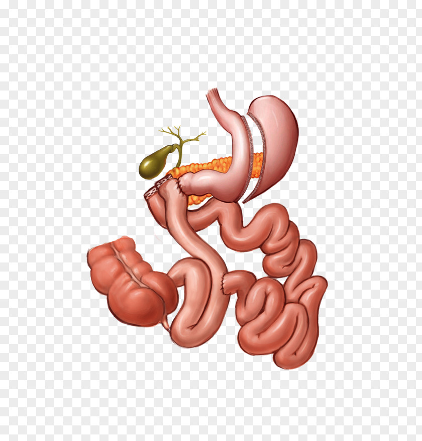 Duodenal Switch Thumb Kielbasa Cartoon Organism PNG