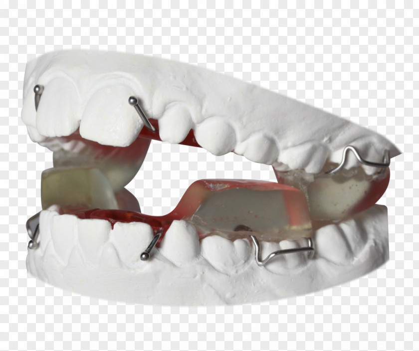 Tooth Orthodontics Twin Block Appliance Retainer Bionator PNG
