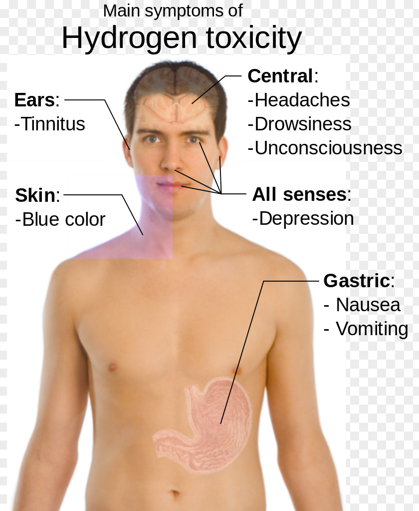 Health Symptom Disease Iron Deficiency Multiple Sclerosis PNG