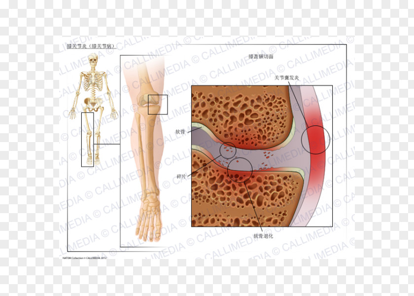 Ráº¯n 3d Knee Arthritis Osteoarthritis PNG