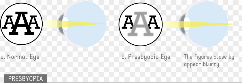 Eye Astigmatism Disease Visual Perception Amblyopia PNG