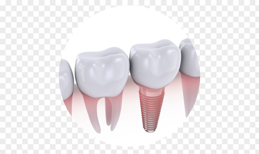 Dental Implant Dentistry Dentures Crown PNG