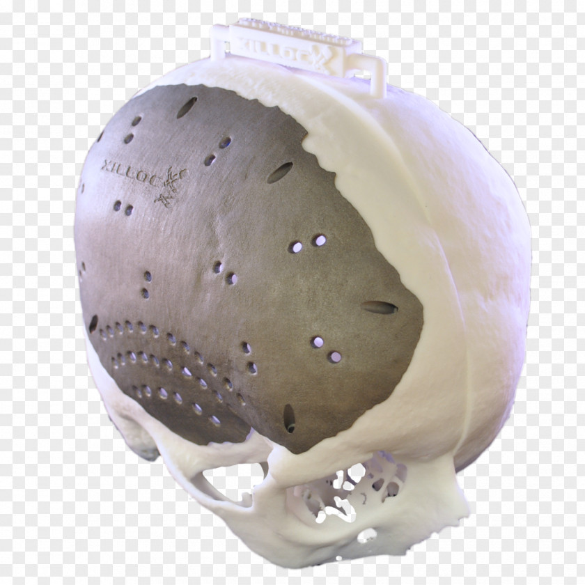 Skull Cranioplasty Brain Implant Titanium PNG