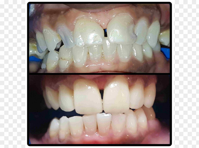 Crown Tooth Veneer Dental Implant Dentist PNG