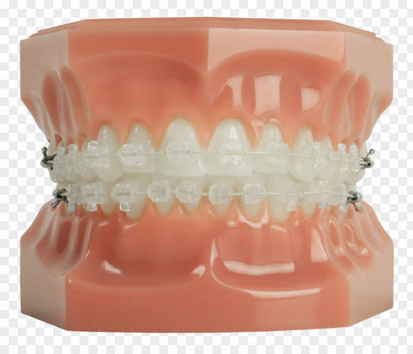 Teeth Model Human Tooth Dental Braces Clear Aligners Dentistry PNG