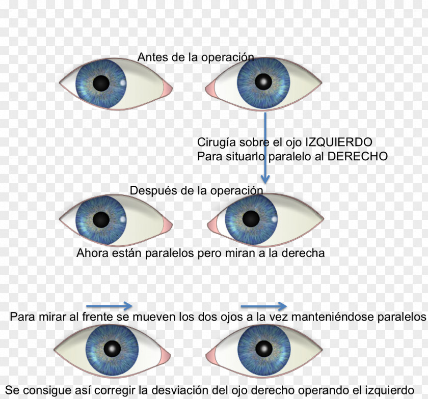 Eye Strabismus Esotropia Ophthalmology Surgery PNG