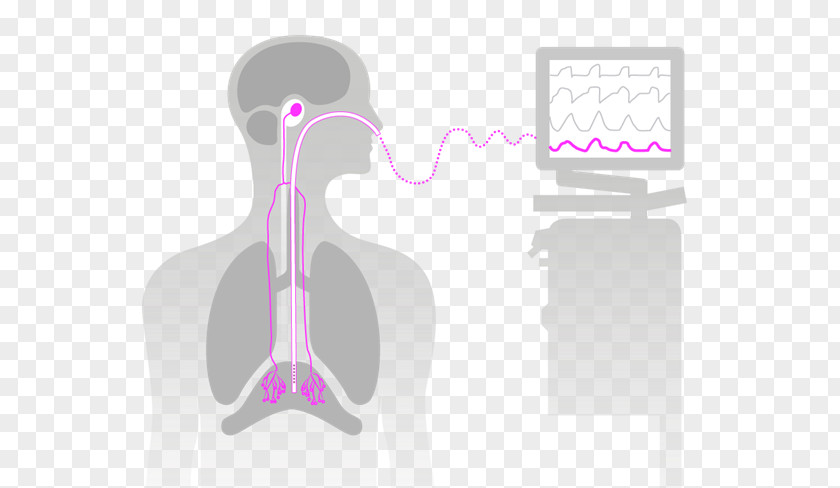 Abdominal Movement Neurally Adjusted Ventilatory Assist Mechanical Ventilation Catheter Medical Ventilator Maquet PNG