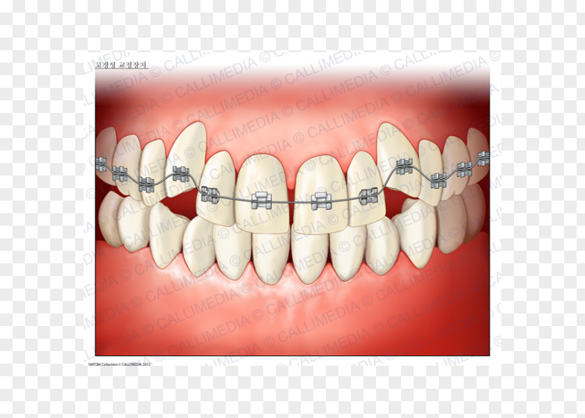 Tooth Dentistry Dental Braces Orthodontics Medicine PNG